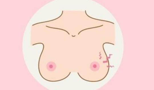 乳頭濕疹有哪些癥狀?為什么會(huì)患乳頭濕疹?