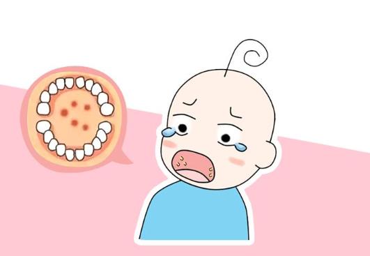 皰疹性咽峽炎的病因是什么?皰疹性咽峽炎的癥狀