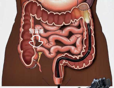 腸結(jié)核會傳染嗎?腸結(jié)核的癥狀是什么