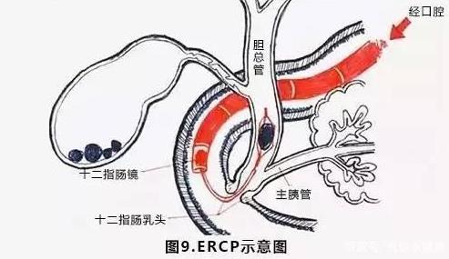 膽管炎要治療多久?膽管炎的危害是什么