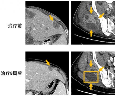 兩個(gè)月咳出腫瘤組織,高響應(yīng)率非小細(xì)胞肺癌靶向藥將改變患者命運(yùn)
