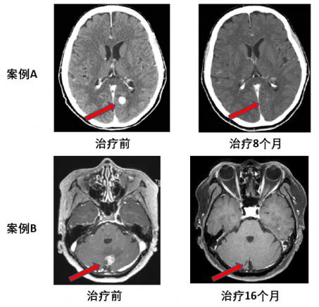兩個(gè)月咳出腫瘤組織,高響應(yīng)率非小細(xì)胞肺癌靶向藥將改變患者命運(yùn)