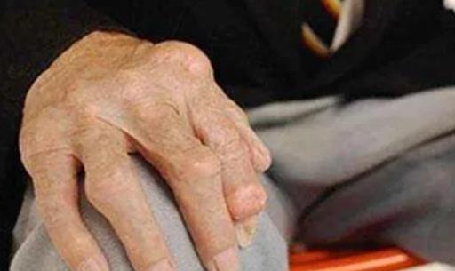 什么是纖維性骨炎?纖維性骨炎有哪些癥狀?