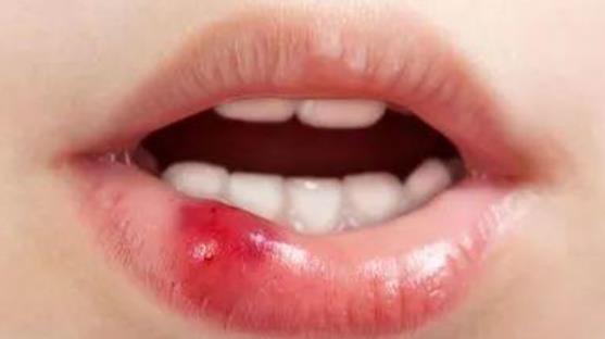 什么是腺性唇炎?腺性唇炎有哪些癥狀?