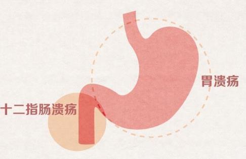 消化性潰瘍是什么回事?消化性潰瘍的癥狀