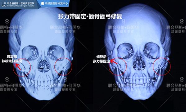 顴骨內(nèi)推,為什么首選張力帶固定技術(shù)?【聯(lián)合麗格何照華教授】
