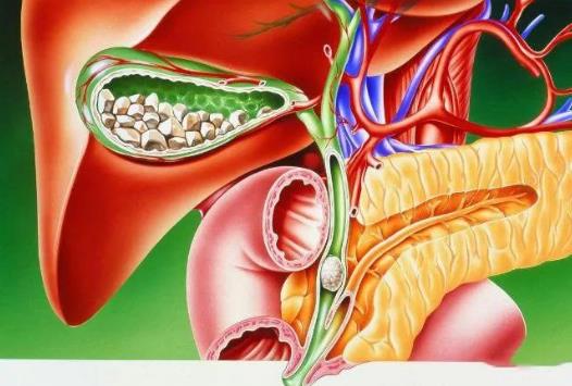 如何預(yù)防膽囊息肉?膽囊息肉的危害