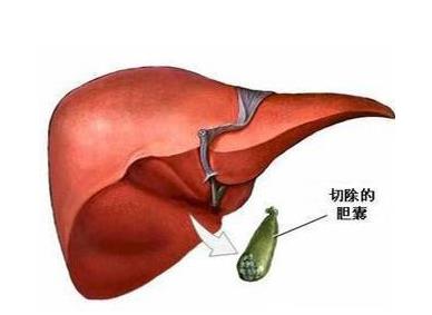 如何預(yù)防膽囊息肉?膽囊息肉的危害