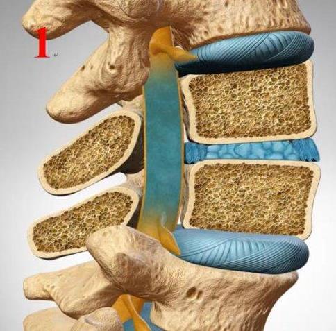 嚴重骨質疏松的危害有哪些?骨質疏松癥的預防方法