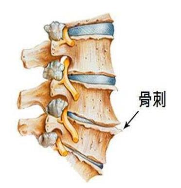 什么叫骨質(zhì)增生?骨質(zhì)增生要注意什么事項(xiàng)
