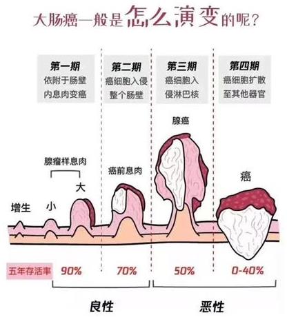 昆明東大肛腸醫(yī)院提醒:腸息肉會復(fù)發(fā),切除后切記要定期復(fù)查