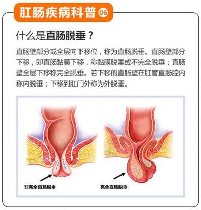 昆明東大肛腸醫(yī)院提醒:肛門脫出的肉球除了痔瘡,還要當(dāng)心是脫肛