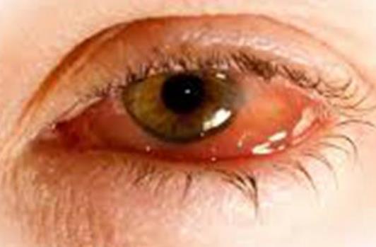 眼睛眼屎多正正常嗎?眼睛眼屎多的原因有哪些?