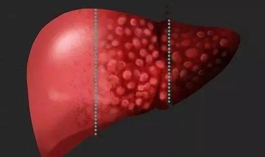 肝臟腫大很嚴(yán)重嗎?肝臟腫大有哪些癥狀?