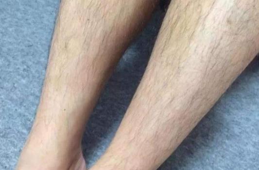 為什么會(huì)汗毛多?汗毛多可以怎么去除?