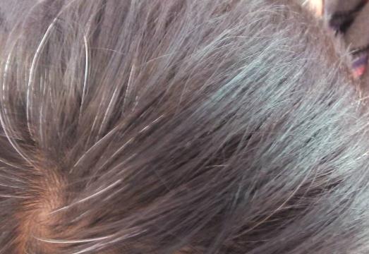 白發(fā)病可以治愈嗎?引起頭發(fā)早白的原因有哪些?
