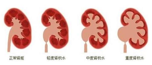 云南結(jié)石病醫(yī)院腎結(jié)石患者:腎結(jié)石癥狀腰疼就像一把刀子來回絞動(dòng)