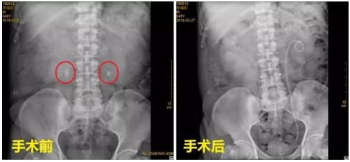 云南結(jié)石病醫(yī)院腎結(jié)石患者:腎結(jié)石癥狀腰疼就像一把刀子來回絞動(dòng)