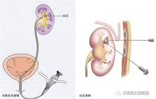 云南結(jié)石病醫(yī)院腎結(jié)石患者:腎結(jié)石癥狀腰疼就像一把刀子來回絞動(dòng)