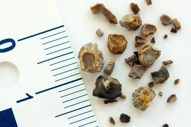 廣州治療腎結(jié)石比較好的醫(yī)院在哪里?廣州治療腎結(jié)石哪個醫(yī)生好?