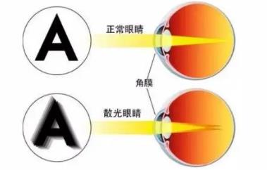 遠(yuǎn)程視覺(jué)謝培英;散光屬于屈光不正的一種