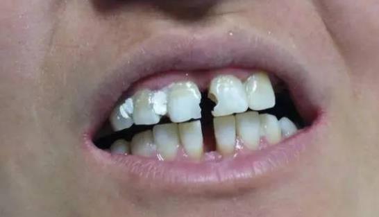 怎么預防牙縫變大?牙縫變大可以怎么辦?