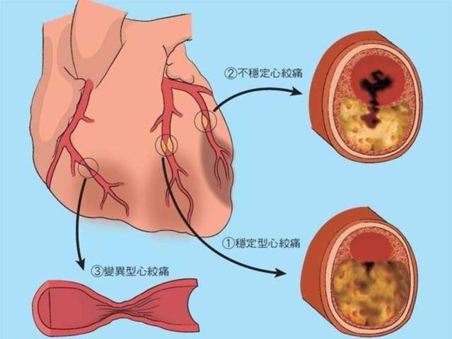 血濁有增無減 冠心病支架和搭橋后仍存生命隱患