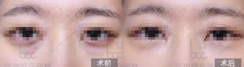 嗨體熊貓針憑什么撐起愛(ài)美客公司千億市值?