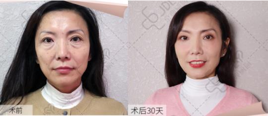 京典麗園不開刀去眼袋多少錢?正常情況下應(yīng)該是多少?
