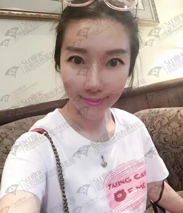 沈陽玻尿酸案例,有它才是女神的標(biāo)配,重回十八歲!