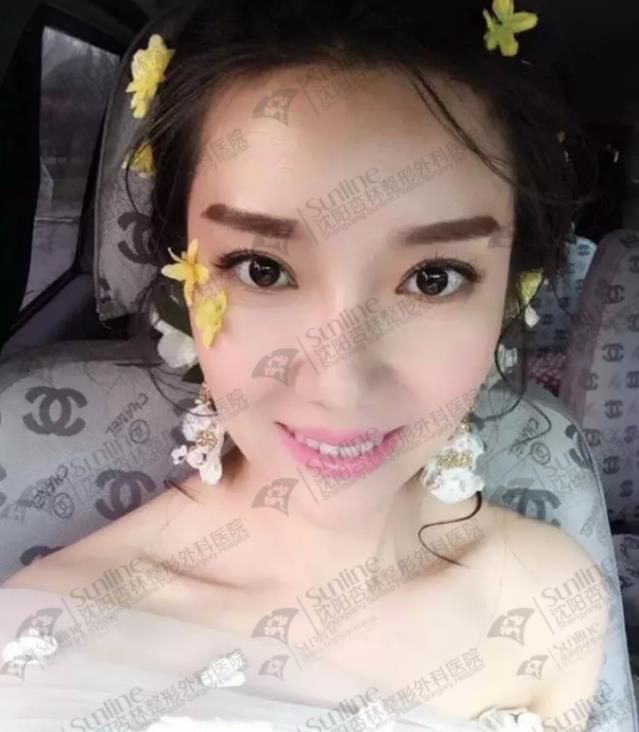 沈陽玻尿酸案例,有它才是女神的標(biāo)配,重回十八歲!