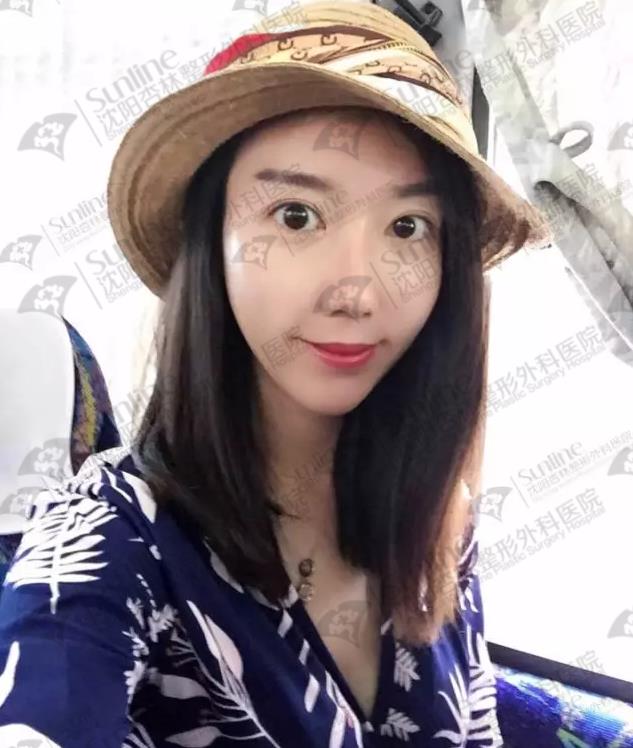 沈陽玻尿酸案例,有它才是女神的標(biāo)配,重回十八歲!