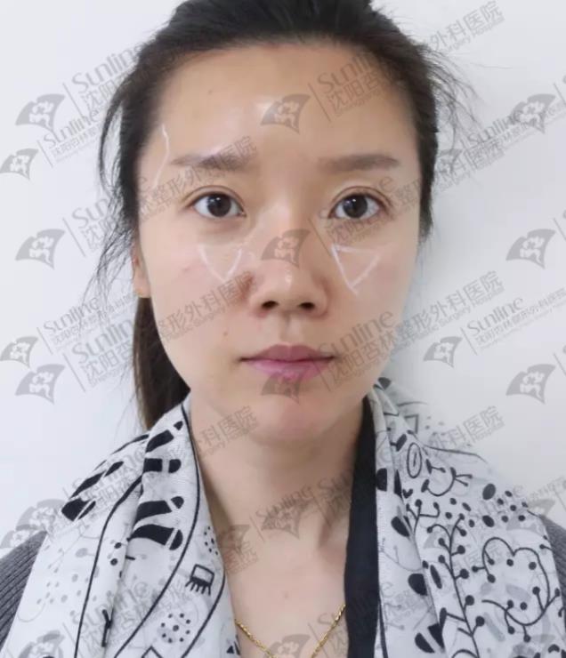 沈陽玻尿酸案例,有它才是女神的標(biāo)配,重回十八歲!
