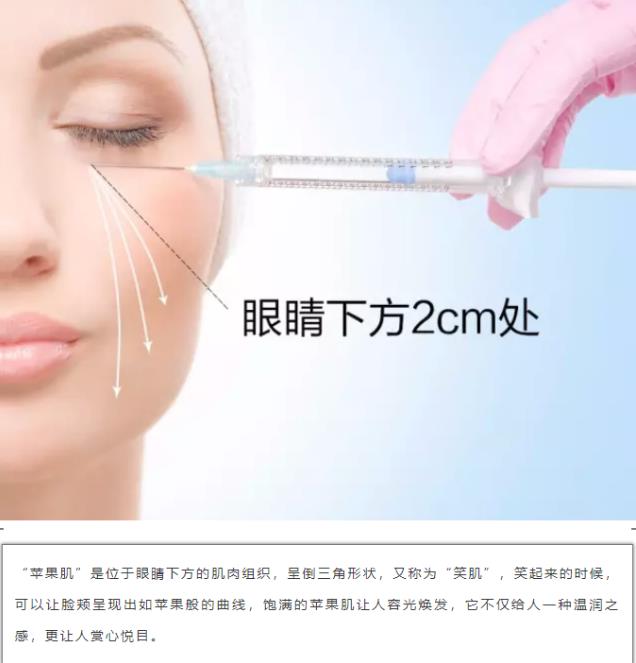 沈陽玻尿酸案例,有它才是女神的標(biāo)配,重回十八歲!