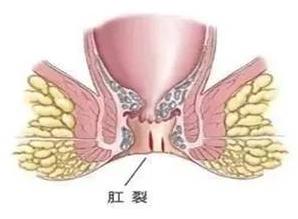 廣州東大肛腸醫(yī)院正規(guī):春季肛腸疾病高發(fā),如何遠(yuǎn)離它?