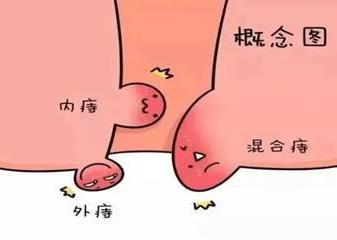 廣州東大肛腸醫(yī)院正規(guī):春季肛腸疾病高發(fā),如何遠(yuǎn)離它?