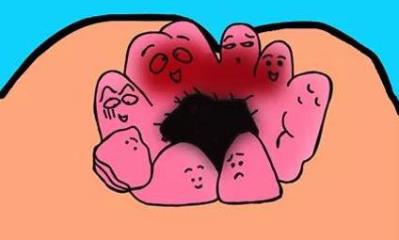 昆明東大肛腸醫(yī)院好嗎?“菊花”因痔綻放,面對(duì)嵌頓痔該怎么處理