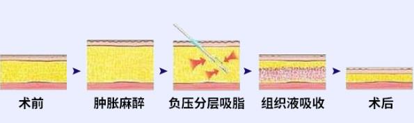 北京煤醫(yī)李艷博士微塑全層纖巧吸脂 ,不止于瘦,更重于塑