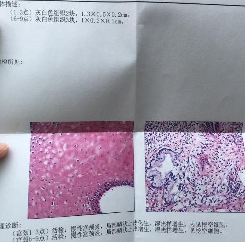 3個高危1個低危HPV感染,轉(zhuǎn)陰經(jīng)歷分享給大家