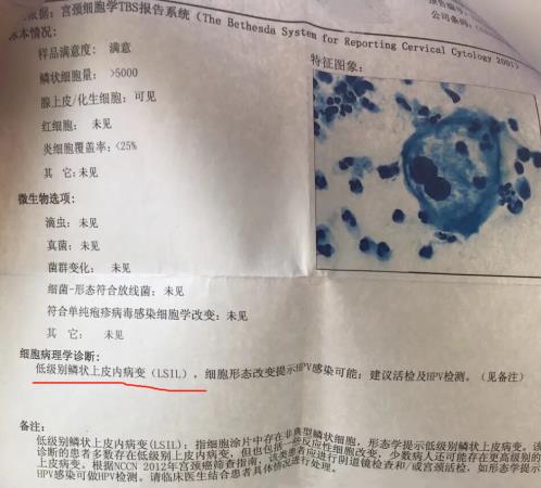 3個高危1個低危HPV感染,轉(zhuǎn)陰經(jīng)歷分享給大家
