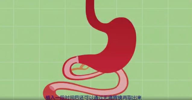 國內(nèi)“胃轉(zhuǎn)流支架系統(tǒng)”首例注冊臨床試驗由糖吉醫(yī)療成功完成!
