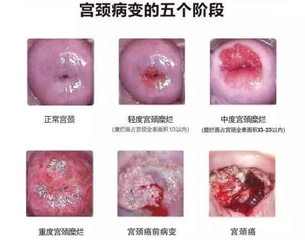 洛蔓蒂克:從陰道炎到宮頸癌的全過(guò)程!趕緊收藏