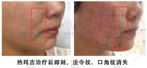 近20年臨床數(shù)據(jù)認(rèn)證,熱瑪吉抗衰實(shí)力不是蓋的!