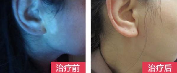 煙臺(tái)治白巔力推煙臺(tái)半島好,面部白斑別苦惱