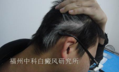「分享」患白癜風三年的福州患者的經(jīng)驗分享_福州中科醫(yī)院