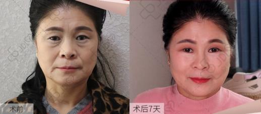 京典麗園去眼袋認為:眼袋如果放任不管,加重眼袋下垂!