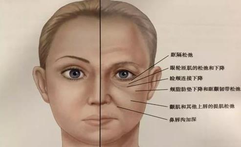 京典麗園去眼袋認為:眼袋如果放任不管,加重眼袋下垂!