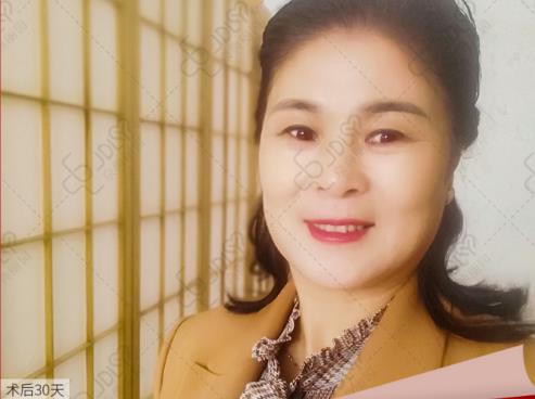 京典麗園去眼袋認為:眼袋如果放任不管,加重眼袋下垂!