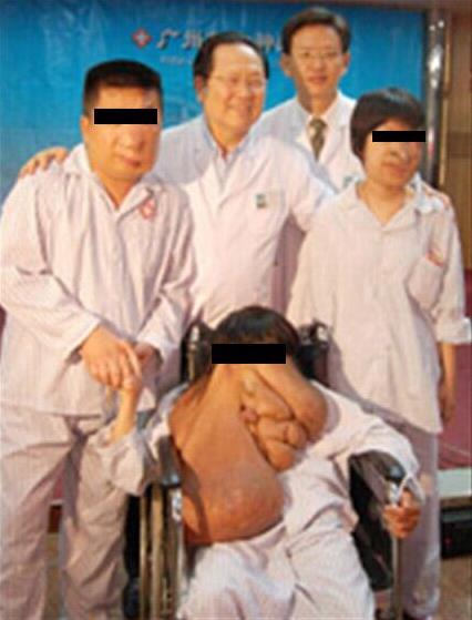 廣州腫瘤專(zhuān)家,黃春才成功治療案例