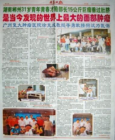 廣州腫瘤專(zhuān)家,黃春才成功治療案例
